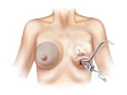 Saline breast implant insertion drawing esprit® cosmetic surgeons